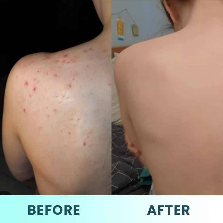 LIMETOW™ Back Acne Treatment Spray