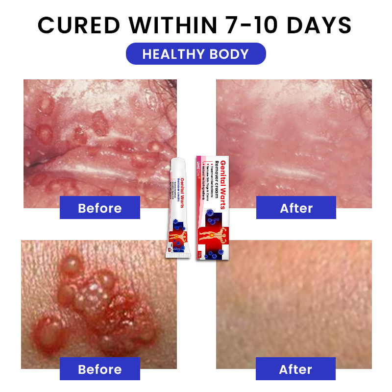 Official Store: LIMETOW® Genital Warts Remover Cream