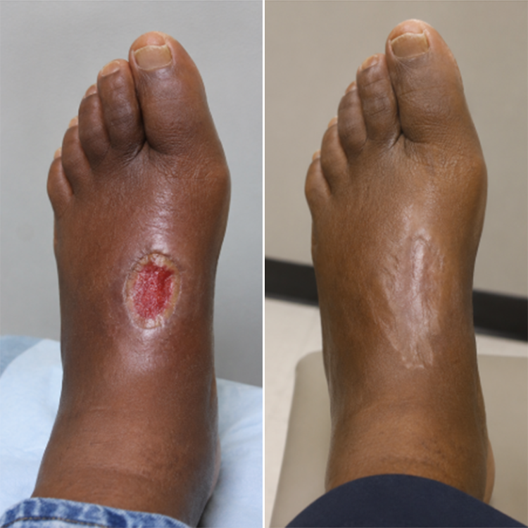 LIMETOW® GLUCOSHIELD WOUND SPRAY! BEE VENOM-POWERED CARE FOR WOUNDS & FRAGILE SKIN!