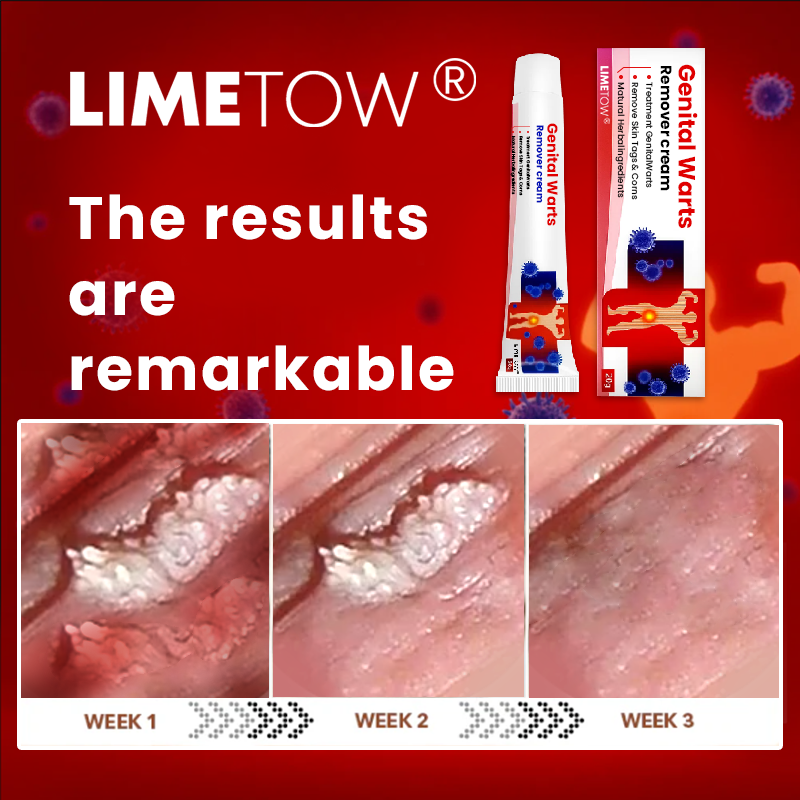 Official Store: LIMETOW® Genital Warts Remover Cream