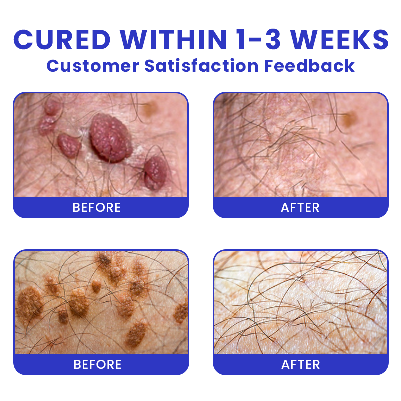 Official Store: LIMETOW® Genital Warts Remover Cream