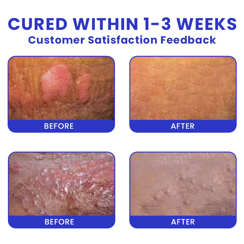 Official Store: LIMETOW® Genital Warts Remover Cream