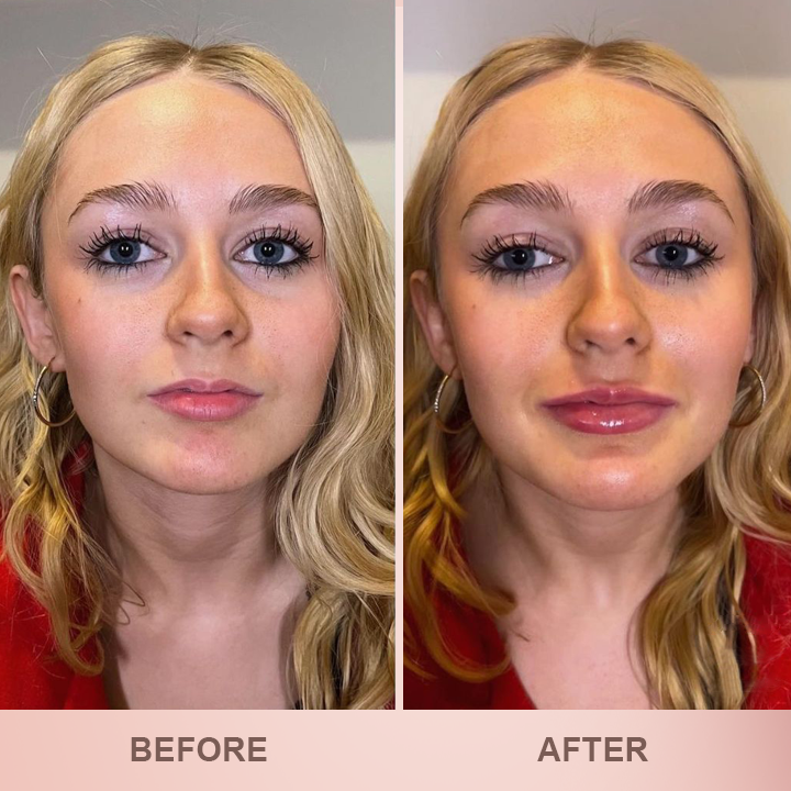 More Value,Same Price✨LIMETOW® Lip Plumper Kit