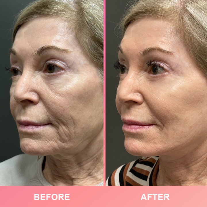 Official Store: LIMETOW™ Compact Anti-Wrinkle Bar