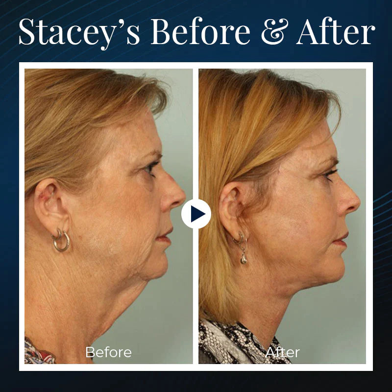 LIMETOW™ Sleeping V-Face Beauty Device