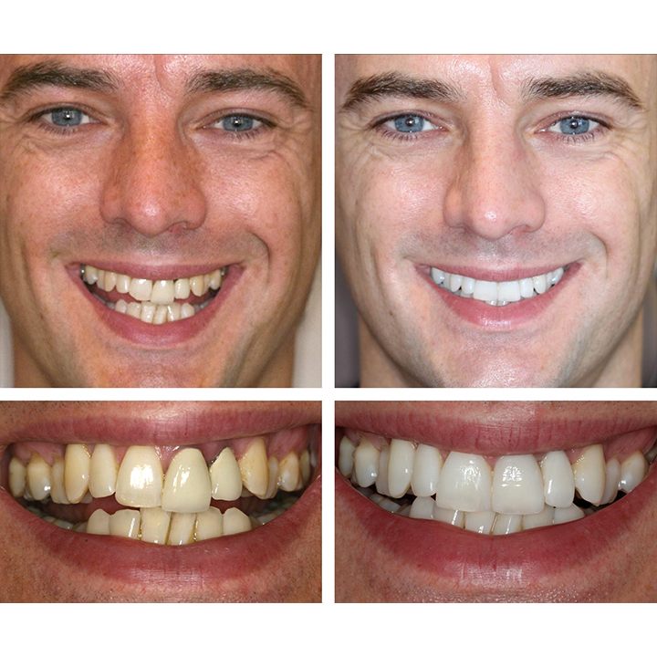 LIMETOW™ Teeth Whitening Essence