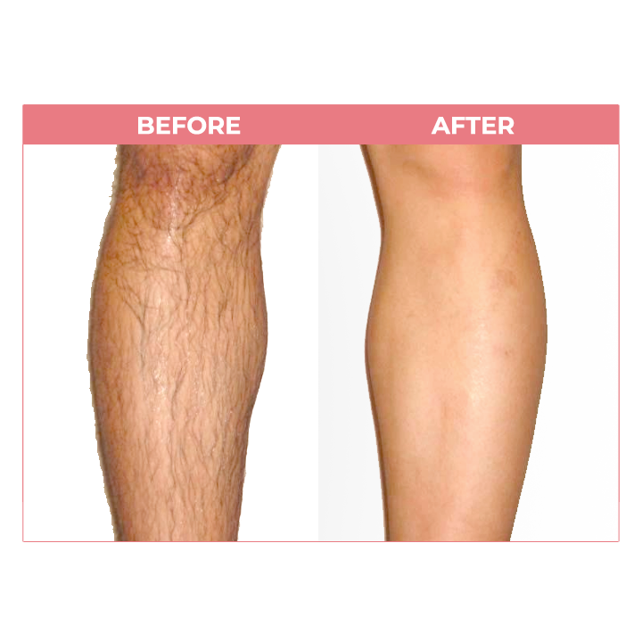 LIMETOW™ Beeswax Hair Removal Mousse