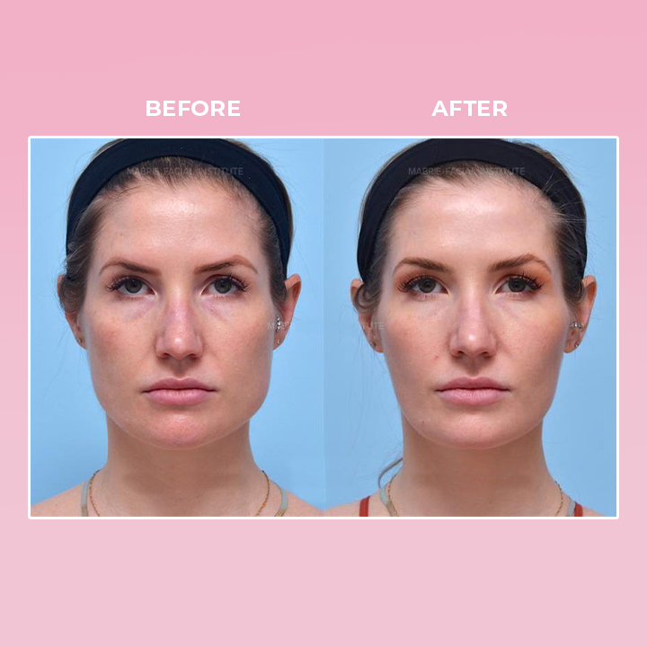 LIMETOW™ V Face Suction Trainer