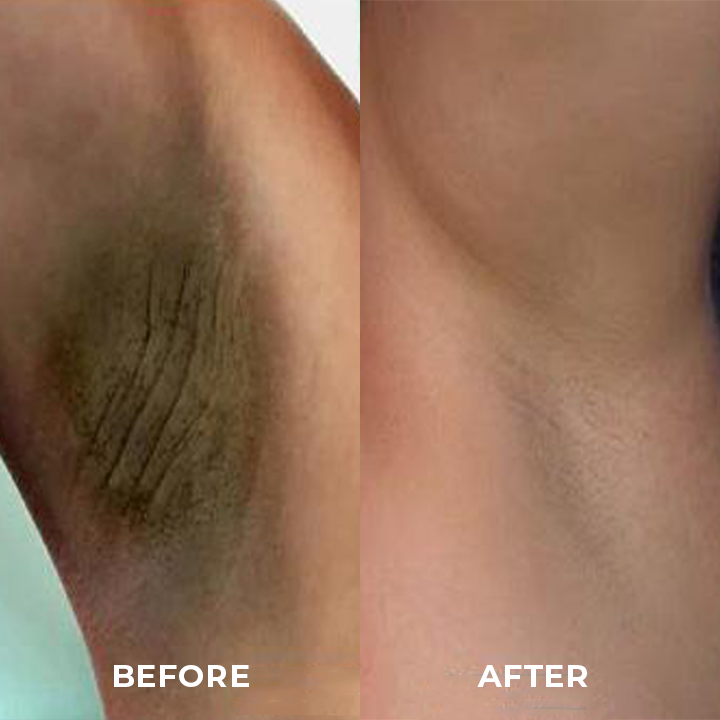 LIMETOW™ Dark Spot Correcting Cream