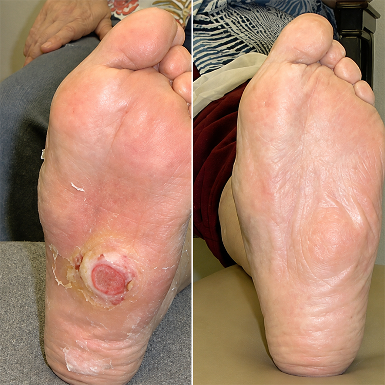 LIMETOW® GLUCOSHIELD WOUND SPRAY! BEE VENOM-POWERED CARE FOR WOUNDS &amp; FRAGILE SKIN!