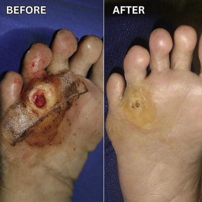 Shield Fragile Diabetic Feet in as Little as 60 Seconds