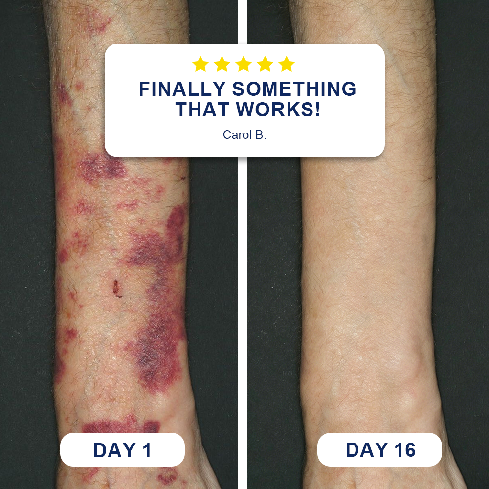 🏆Official US Store🔥LIMETOW® Bruise Repair & Skin-Strengthening Cream