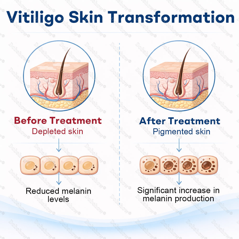 👨‍⚕️🔥Piperine Vitiligo Repigmentation Spray - 🌿Steroid-Free Botanical Formula | Gentle & Effective for All Skin Types