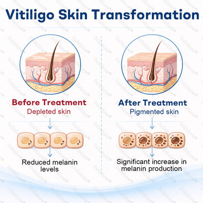 👨‍⚕️🔥Piperine Vitiligo Repigmentation Spray - 🌿Steroid-Free Botanical Formula | Gentle & Effective for All Skin Types