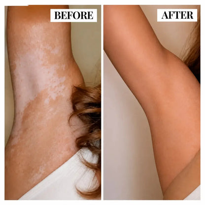 LIMETOW® Herbal Care Cream Targets Vitiligo to Restore Visible Skin Pigment