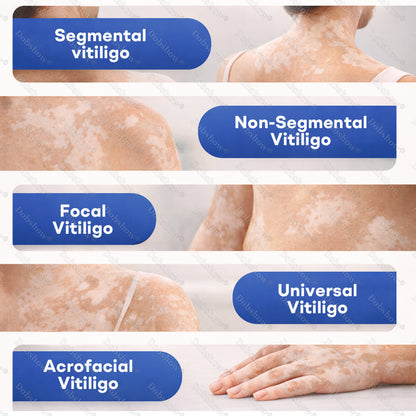 👨‍⚕️🔥Piperine Vitiligo Repigmentation Spray - 🌿Steroid-Free Botanical Formula | Gentle & Effective for All Skin Types