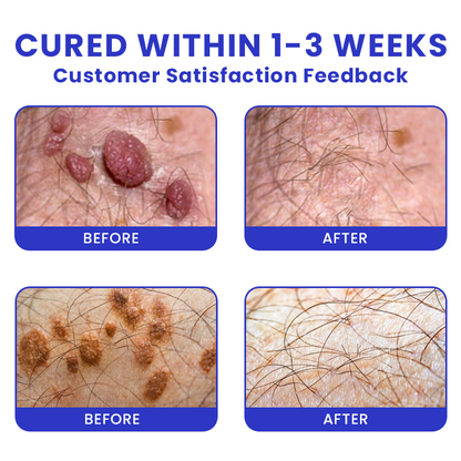 Official Store: LIMETOW® Genital Warts Remover Cream