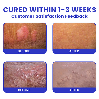 Official Store: LIMETOW® Genital Warts Remover Cream