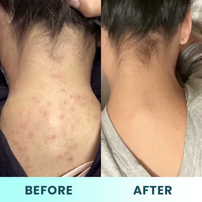 LIMETOW™ Back Acne Treatment Spray