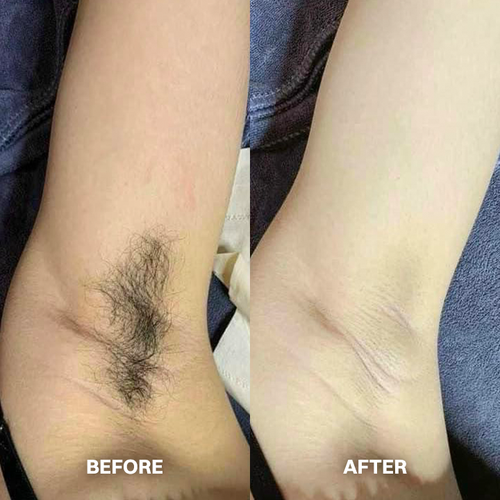 LIMETOW® Cyperus Rotundus Hair Reduction Oil