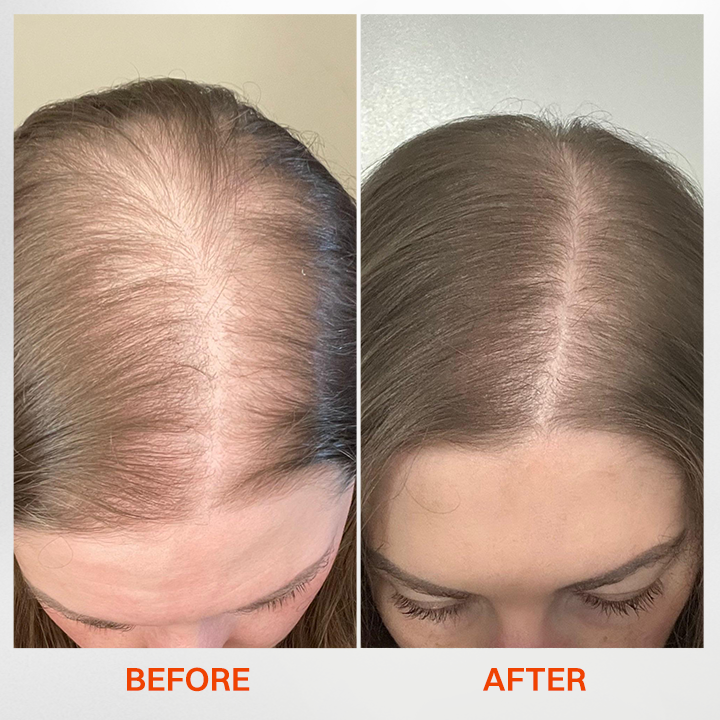 LIMETOW® - Korea's #1 Hair Growth Serum