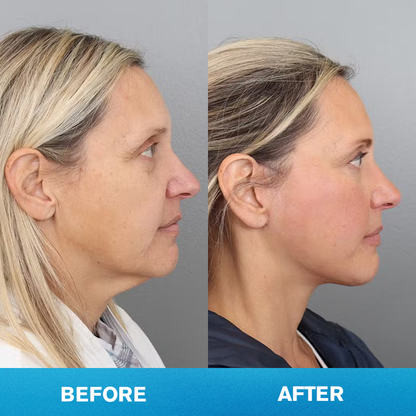 LIMETOW® Invisible Face Lift Tape