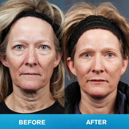 LIMETOW® Invisible Face Lift Tape