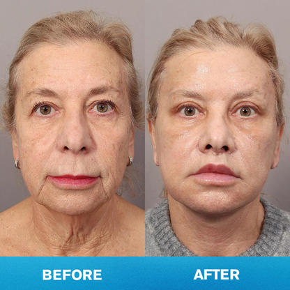 LIMETOW® Invisible Face Lift Tape