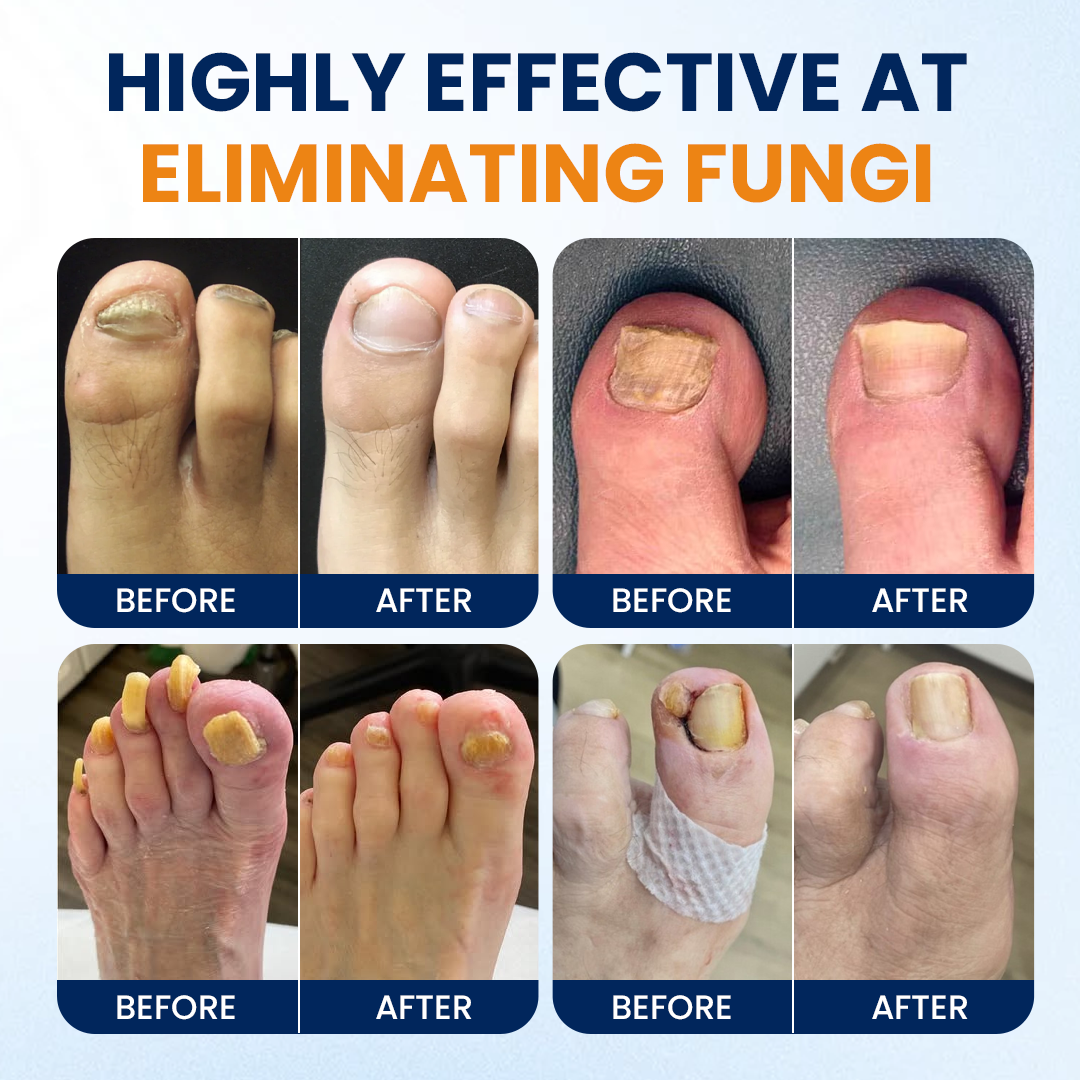 Timilk® Nail fungus relief spray