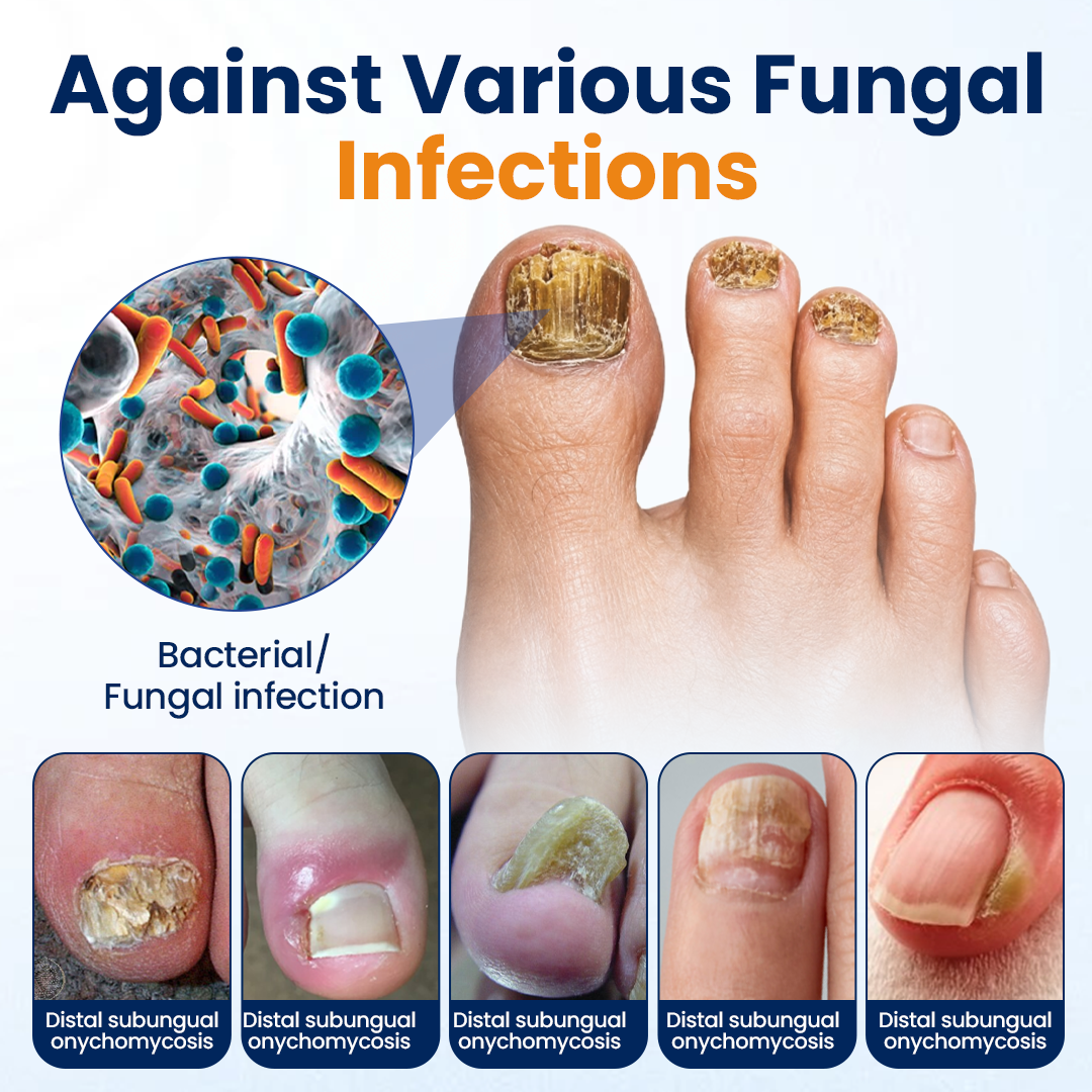 Timilk® Nail fungus relief spray