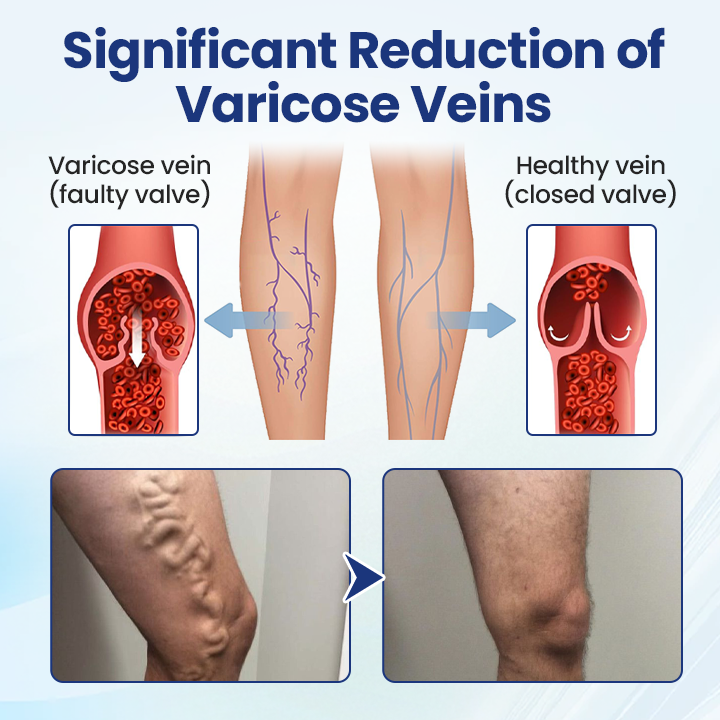 Timilk® Deep Vein Repair Microneedle Patch