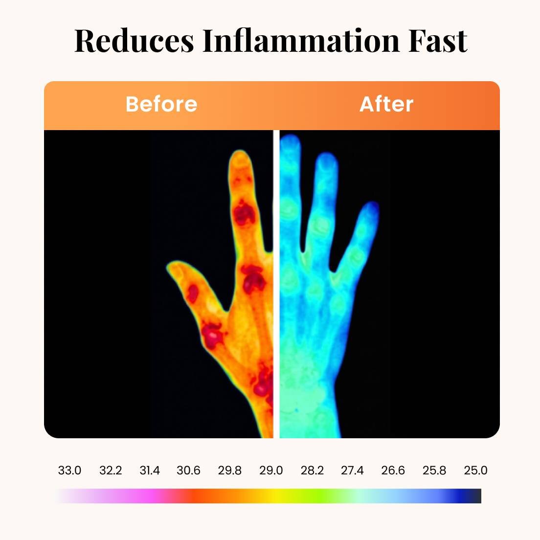 Relieve Hand & Finger Arthritis at the Source Without Pills or Side Effects