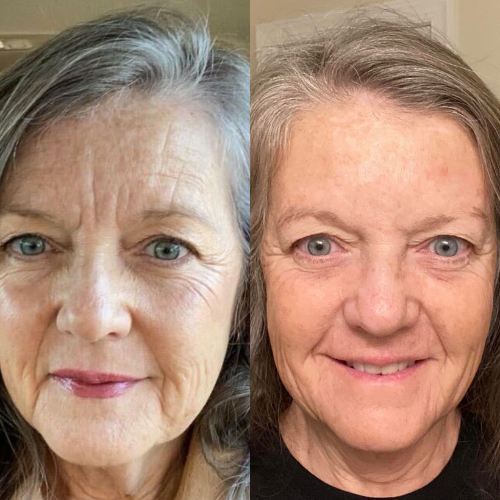 LIMETOW® Forehead & Between the Eyes Facial Patches