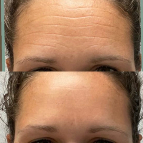 LIMETOW® Forehead & Between the Eyes Facial Patches