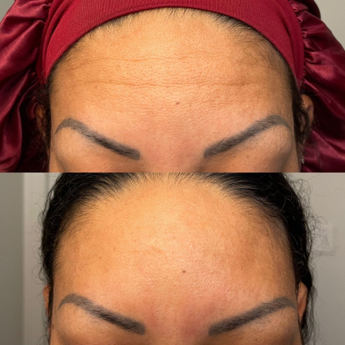 LIMETOW® Forehead & Between the Eyes Facial Patches