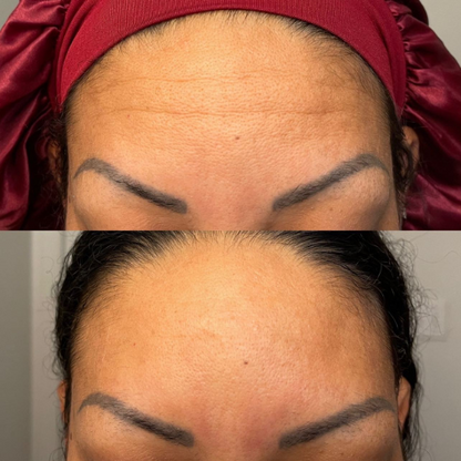 LIMETOW® Forehead & Between the Eyes Facial Patches