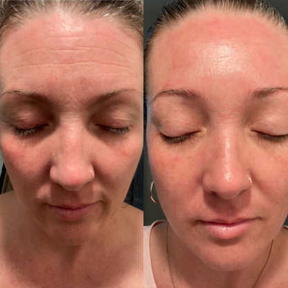 LIMETOW® Forehead & Between the Eyes Facial Patches