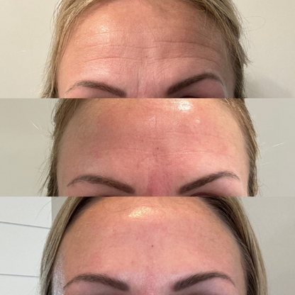 LIMETOW® Forehead & Between the Eyes Facial Patches