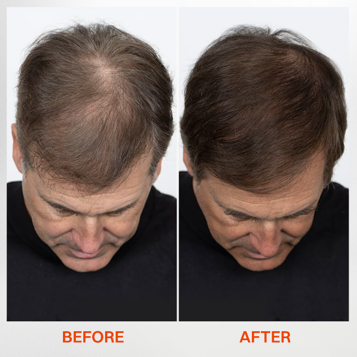 LIMETOW® - Korea's #1 Hair Growth Serum