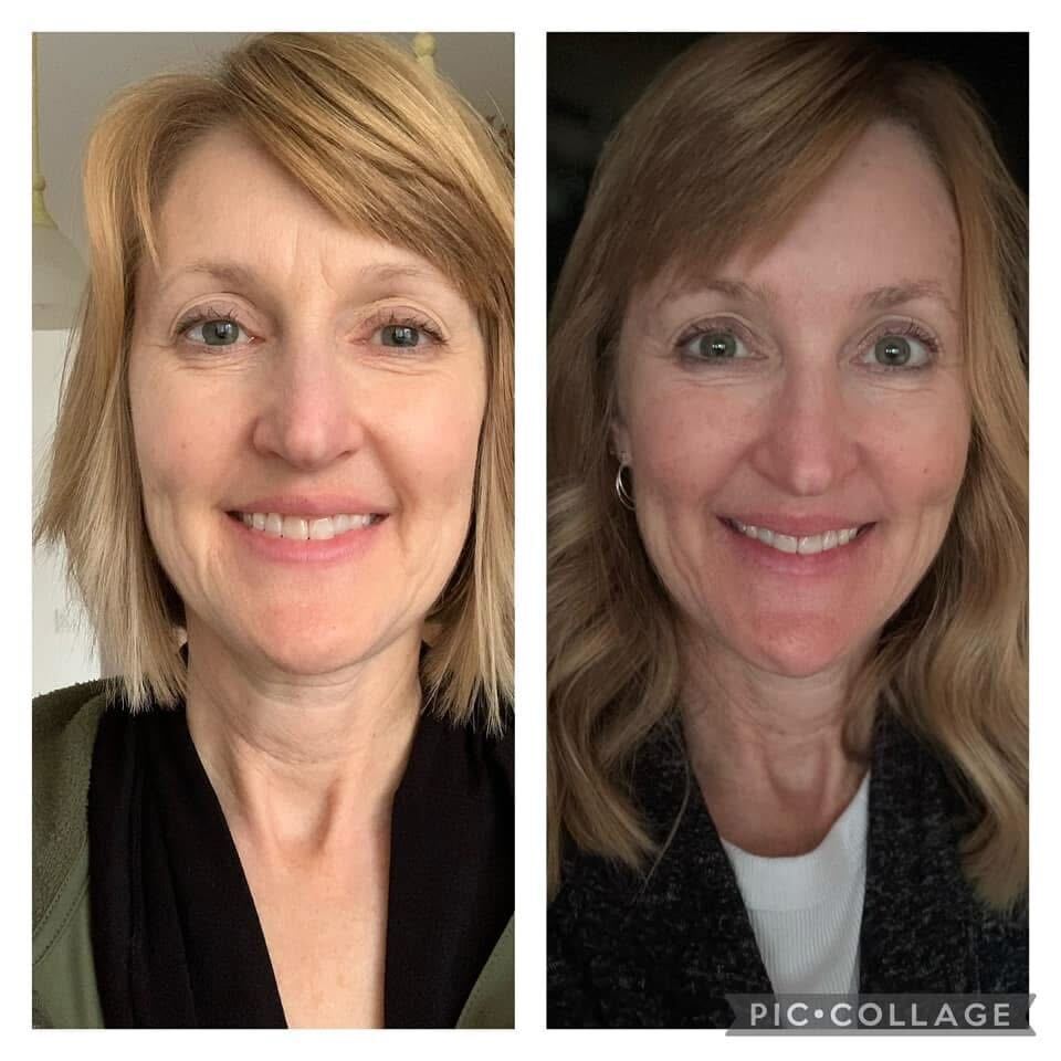 LIMETOW® Forehead & Between the Eyes Facial Patches