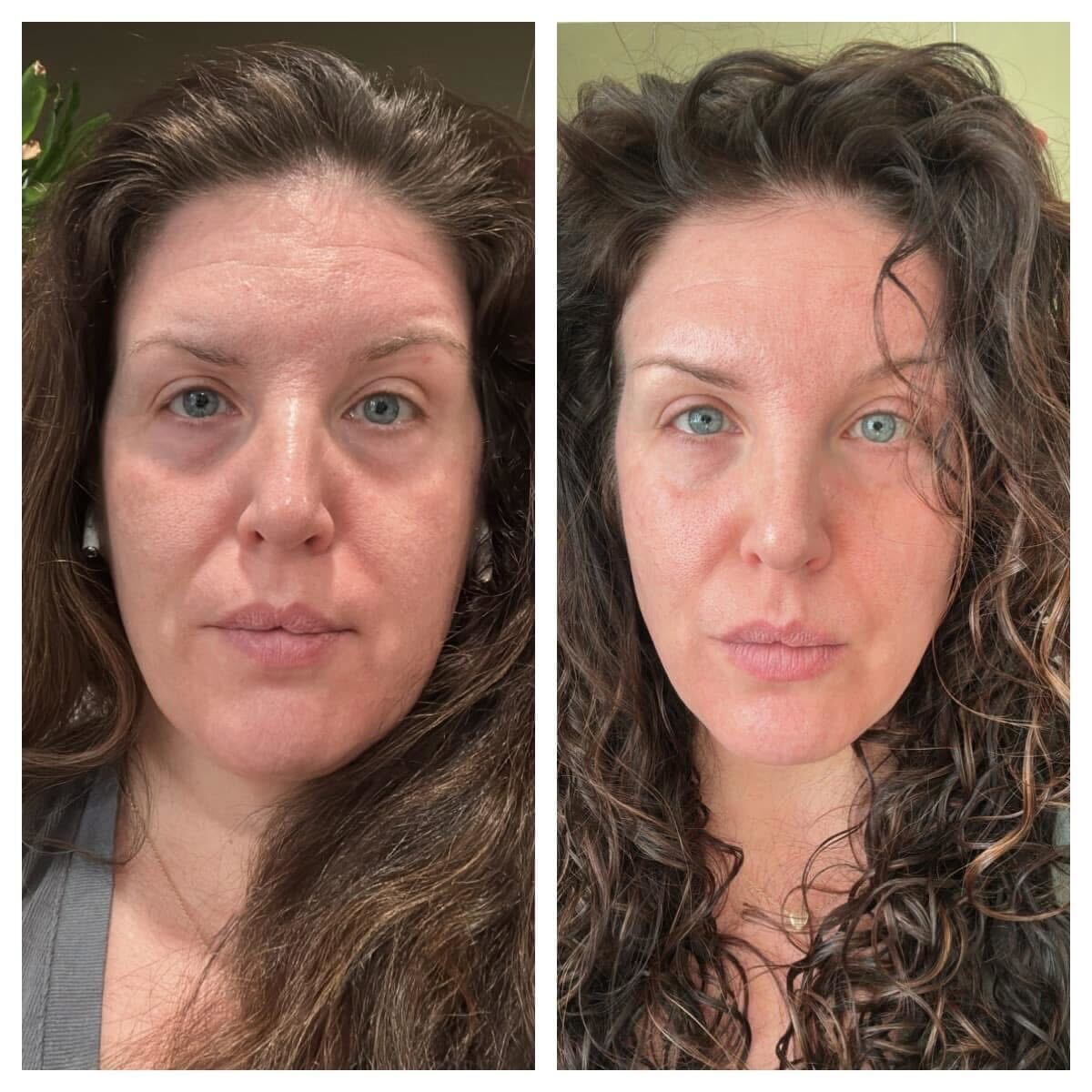 LIMETOW® Forehead & Between the Eyes Facial Patches