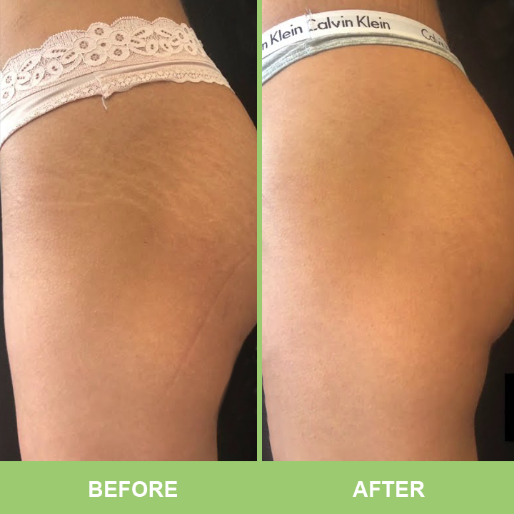 LIMETOW™ Stretch Removing Cream