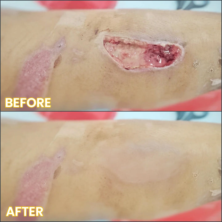 LIMETOW®  Bedsore Cream