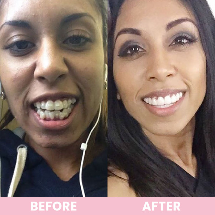 LIMETOW™ Love Your Smile with Custom-Made Veneers