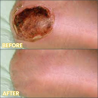 LIMETOW®  Bedsore Cream