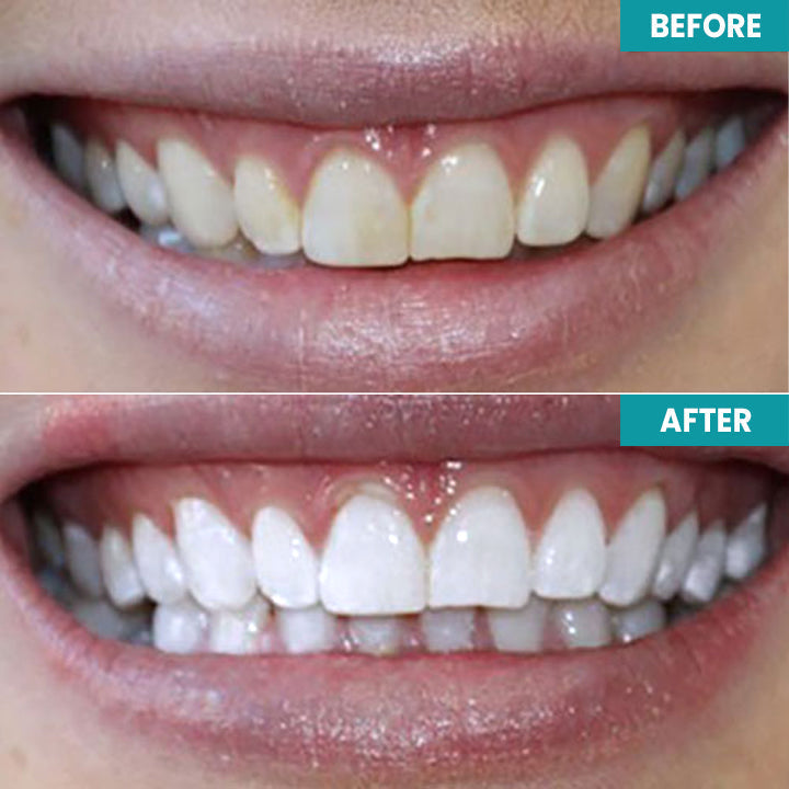 ⏰Limited Time Offer⏰ LIMETOW™ Instant Teeth Whitening Paint