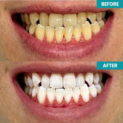 ⏰Limited Time Offer⏰ LIMETOW™ Instant Teeth Whitening Paint