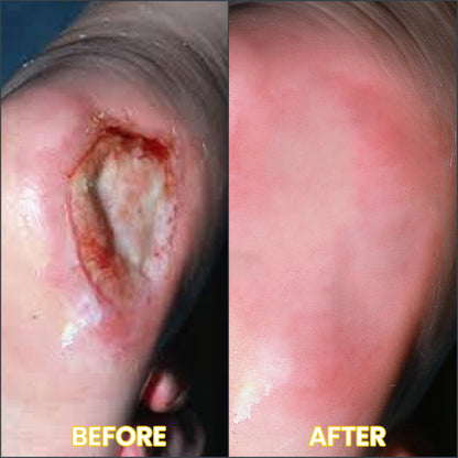 LIMETOW®  Bedsore Cream