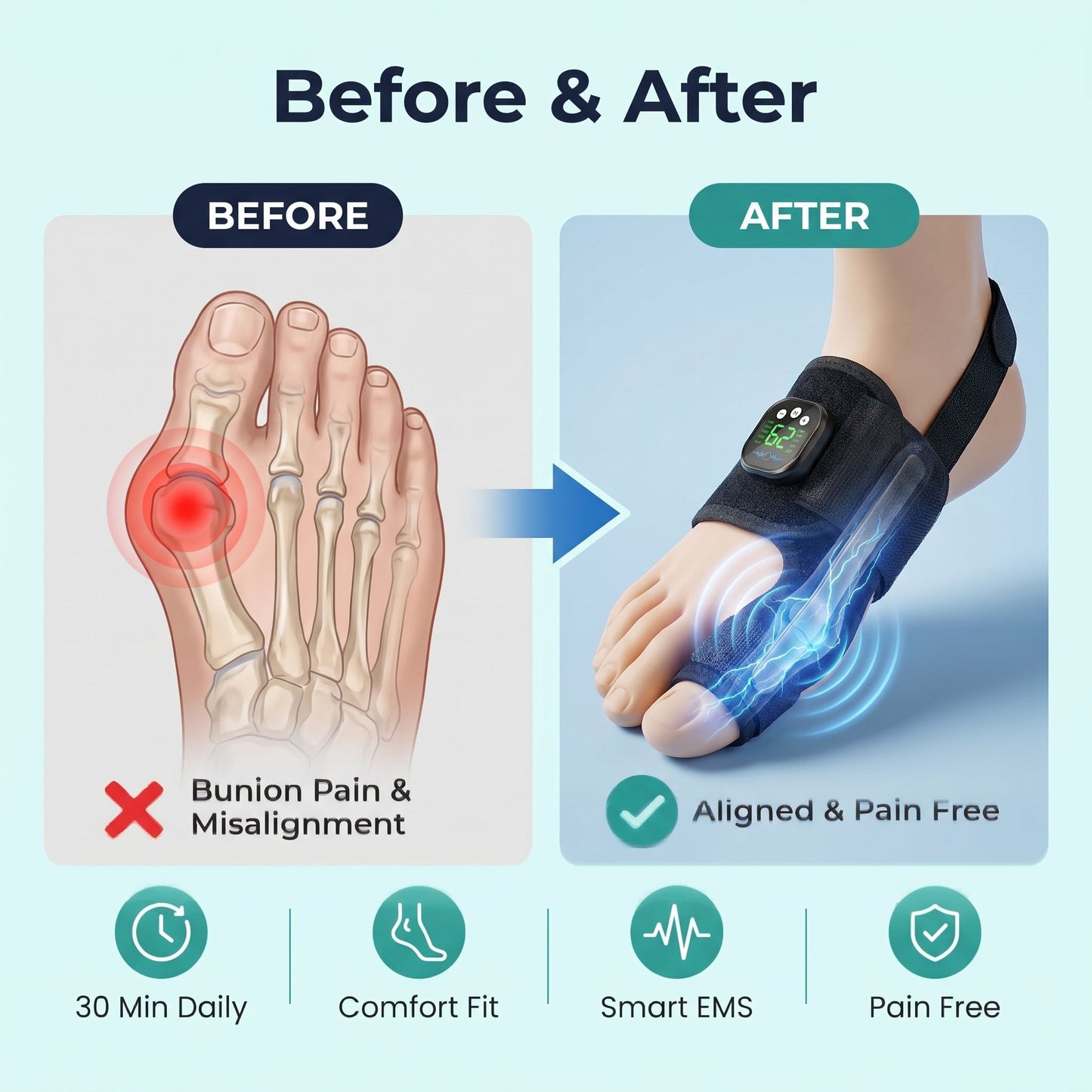 Nexalign Pro — EMS Bunion Corrector
