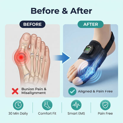 Nexalign Pro — EMS Bunion Corrector